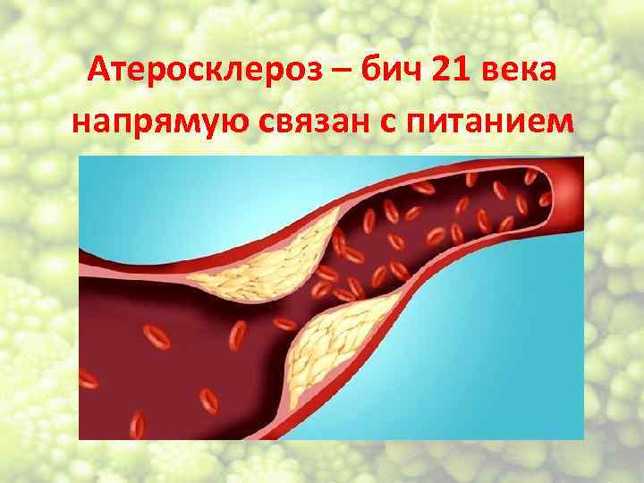 Атеросклероз – бич 21 века напрямую связан с питанием 