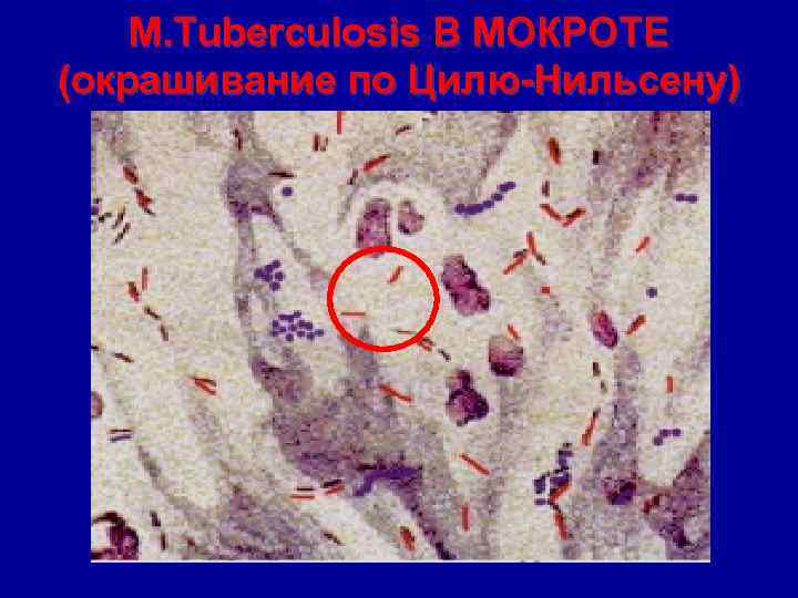 M. Tuberculosis В МОКРОТЕ (окрашивание по Цилю-Нильсену) 