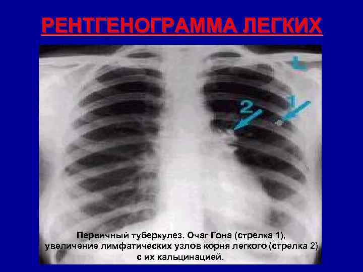 РЕНТГЕНОГРАММА ЛЕГКИХ Первичный туберкулез. Очаг Гона (стрелка 1), увеличение лимфатических узлов корня легкого (стрелка