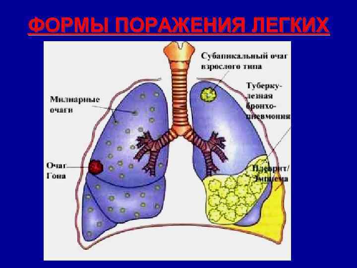 ФОРМЫ ПОРАЖЕНИЯ ЛЕГКИХ 