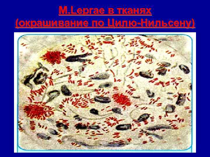 M. Leprae в тканях (окрашивание по Цилю-Нильсену) 