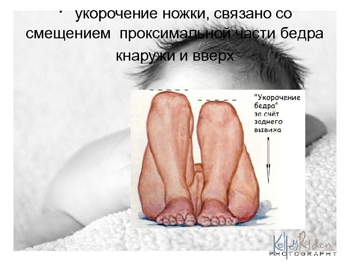 · укорочение ножки, связано со смещением проксимальной части бедра кнаружи и вверх 