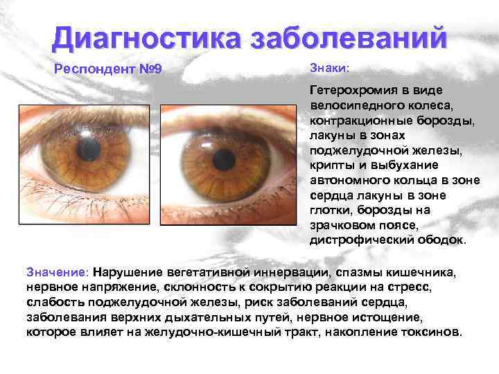 Диагностика заболеваний Респондент № 9 Знаки: Гетерохромия в виде велосипедного колеса, контракционные борозды, лакуны