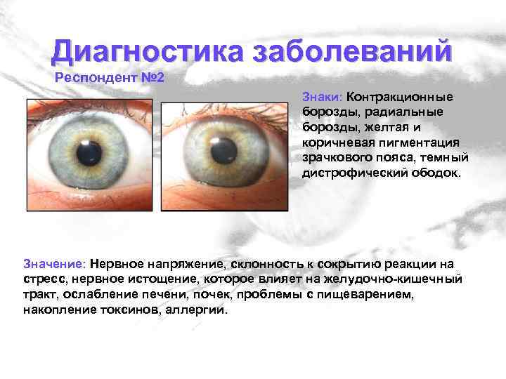 Диагностика заболеваний Респондент № 2 Знаки: Контракционные борозды, радиальные борозды, желтая и коричневая пигментация