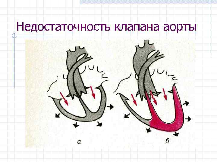 Недостаточность клапана аорты 