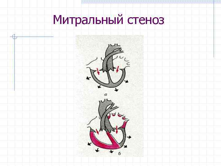 Митральный стеноз 