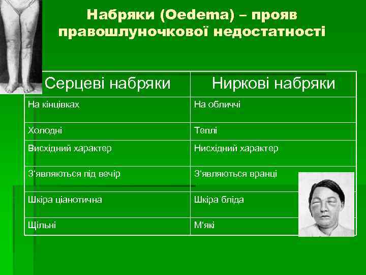 Набряки (Oedema) – прояв правошлуночкової недостатності Серцеві набряки Ниркові набряки На кінцівках На обличчі