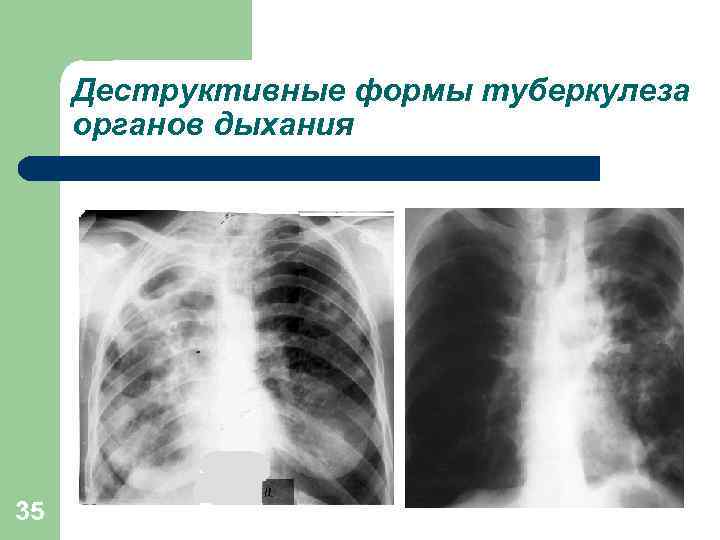 Деструктивные формы туберкулеза органов дыхания 35 