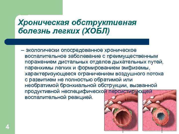 Хроническая обструктивная болезнь легких (ХОБЛ) – экологически опосредованное хроническое воспалительное заболевание с преимущественным поражением