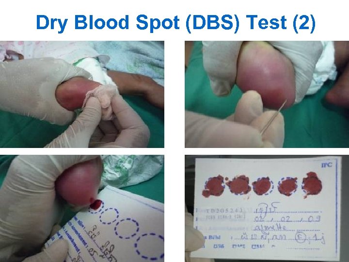 Dry Blood Spot (DBS) Test (2) 17 