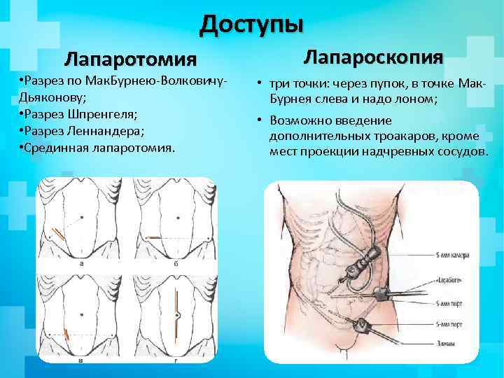 Доступы Лапаротомия • Разрез по Мак. Бурнею-Волковичу. Дьяконову; • Разрез Шпренгеля; • Разрез Леннандера;