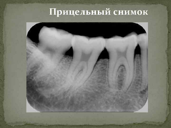 Прицельный снимок. Рентген зуба прицельный снимок. Пародонтальный карман на рентгене. Прицельные рентгеновские снимки зубов. Прицельная внутриротовая рентгенография пародонтит.