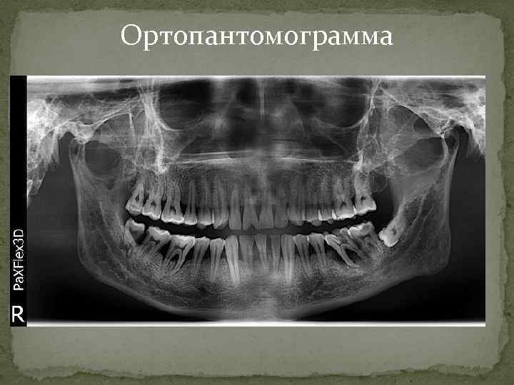 Схема описания ортопантомограммы