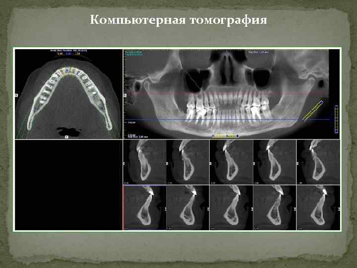 Кт нижней челюсти цена в ульяновске. Компьютерная томография 2 челюсти. Кт челюсти норма сбоку. Кт верхней челюсти и нижней челюсти.