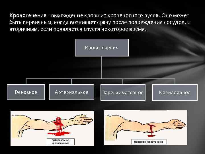 Кровотечение - выхождение крови из кровеносного русла. Оно может быть первичным, когда возникает сразу