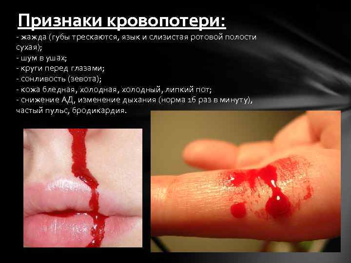 Признаки кровопотери: - жажда (губы трескаются, язык и слизистая ротовой полости сухая); - шум
