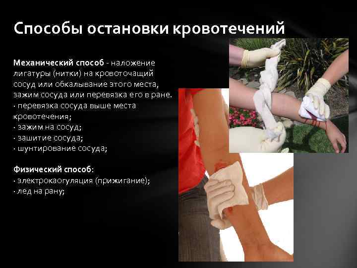 Способы остановки кровотечений Механический способ - наложение лигатуры (нитки) на кровоточащий сосуд или обкалывание