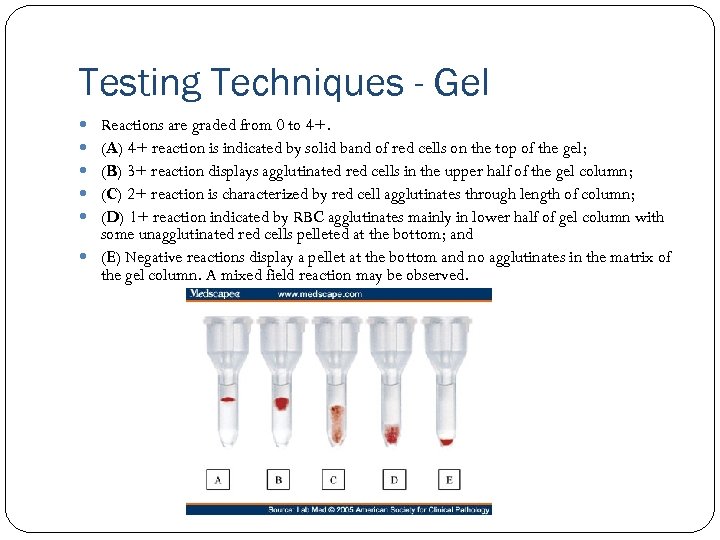 Testing Techniques - Gel Reactions are graded from 0 to 4+. (A) 4+ reaction