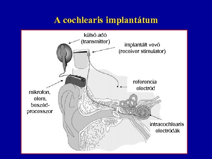 A cochlearis implantátum külső adó (transmitter) mikrofon, elem, beszédprocesszor implantált vevő (receiver stimulator)) referencia
