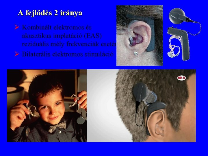 A fejlődés 2 iránya Ø Kombinált elektromos és akusztikus implatáció (EAS) reziduális mély frekvenciák