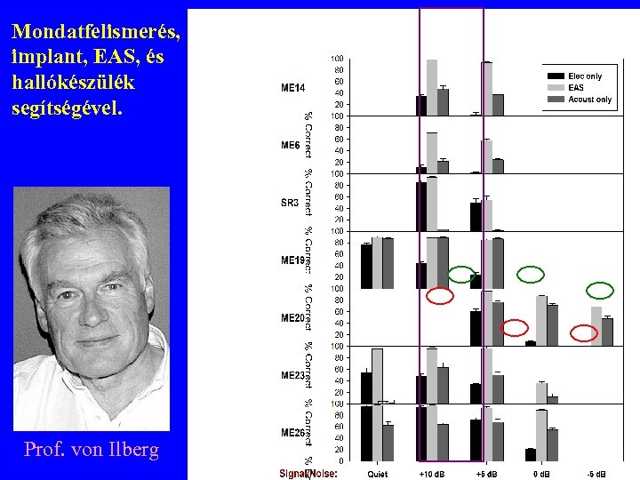 Mondatfelismerés, implant, EAS, és hallókészülék segítségével. Prof. von Ilberg 