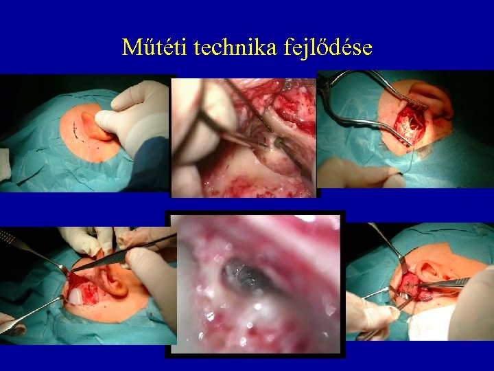Műtéti technika fejlődése 