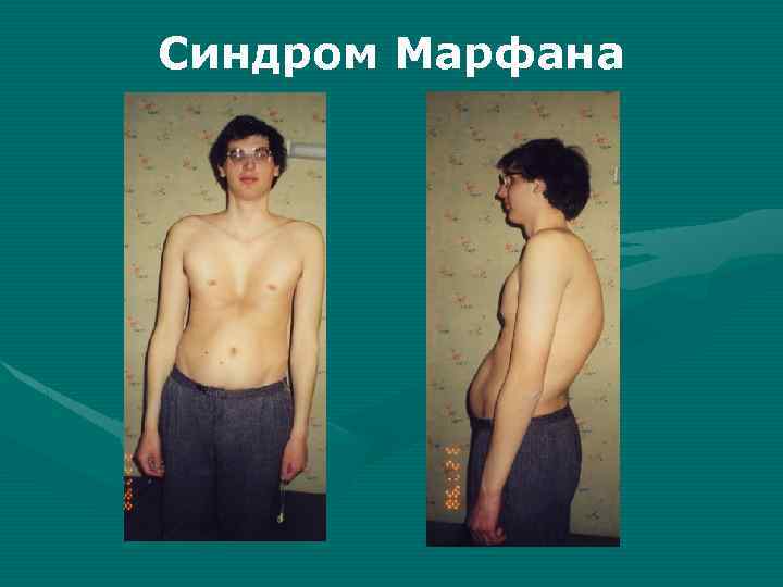 Синдром Марфана 