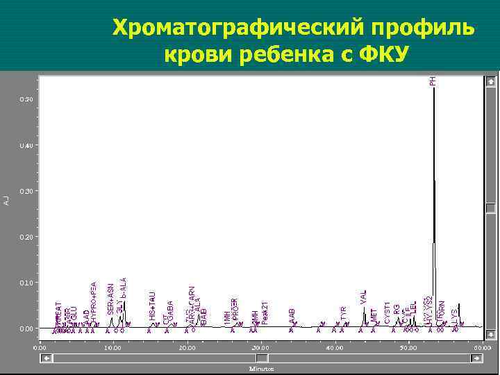 Хроматографический профиль крови ребенка с ФКУ 