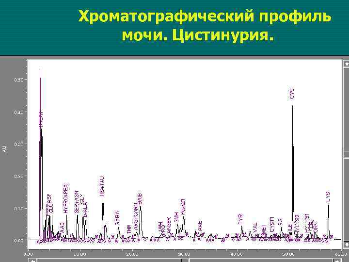 Хроматографический профиль мочи. Цистинурия. 