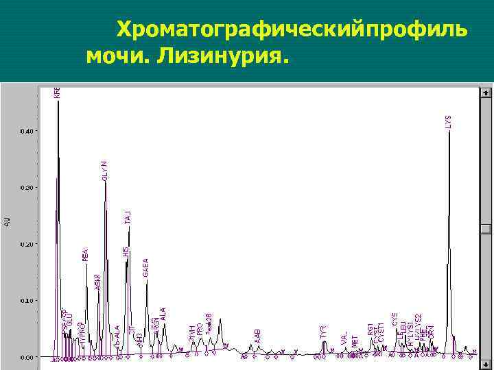 Хроматографическийпрофиль мочи. Лизинурия. 