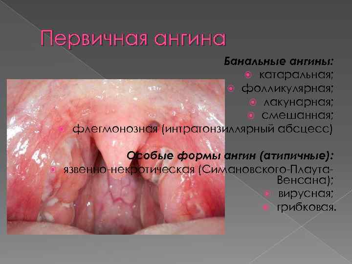 Первичная ангина Банальные ангины: катаральная; фолликулярная; лакунарная; смешанная; флегмонозная (интратонзиллярный абсцесс) Особые формы ангин