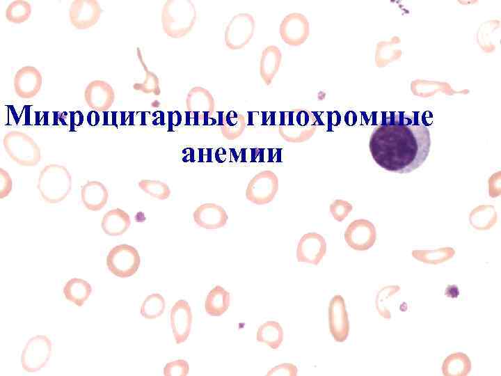 Микроцитарные гипохромные анемии 