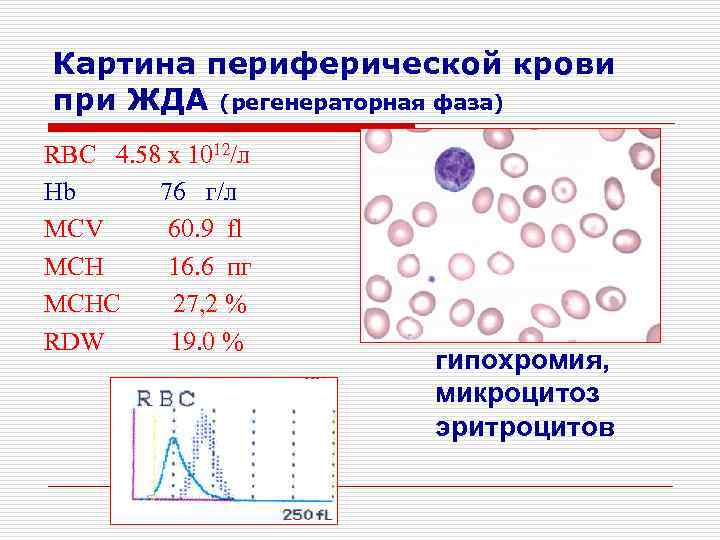 Картина периферической крови при ЖДА (регенераторная фаза) RBC 4. 58 x 1012/л Hb 76