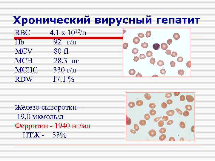 Хронический вирусный гепатит RBC Hb MCV MCHC RDW 4. 1 x 1012/л 92 г/л