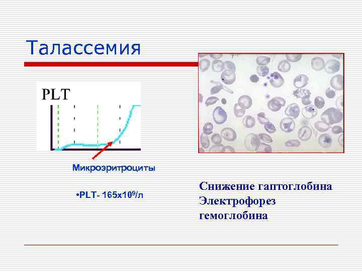 Талассемия Микроэритроциты • PLT- 165 х109/л Снижение гаптоглобина Электрофорез гемоглобина 
