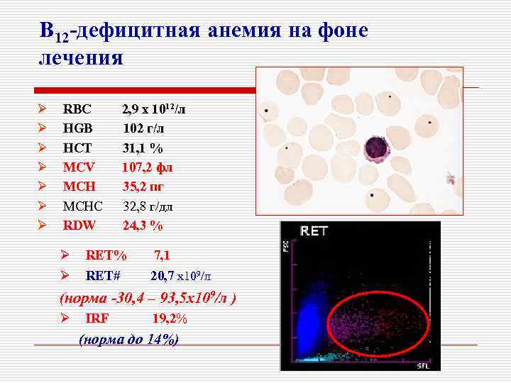 В12 при железодефицитной анемии. Б12 дефицитная анемия показатели крови. Показатели крови при б12 дефицитной анемии. В12 анемия анализ крови показатели. В12 дефицитная анемия анализ.