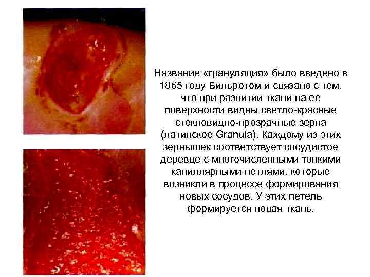 Название «грануляция» было введено в 1865 году Бильротом и связано с тем, что при