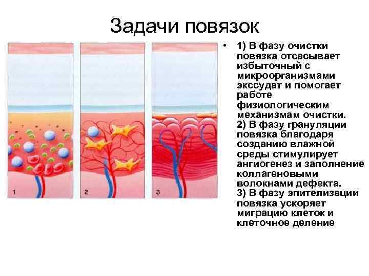 Задачи повязок • 1) В фазу очистки повязка отсасывает избыточный с микроорганизмами экссудат и