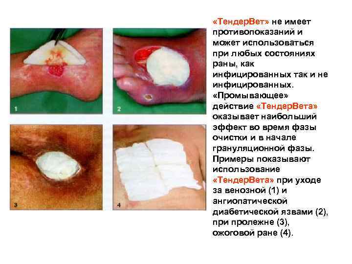  «Тендер. Вет» не имеет противопоказаний и может использоваться при любых состояниях раны, как