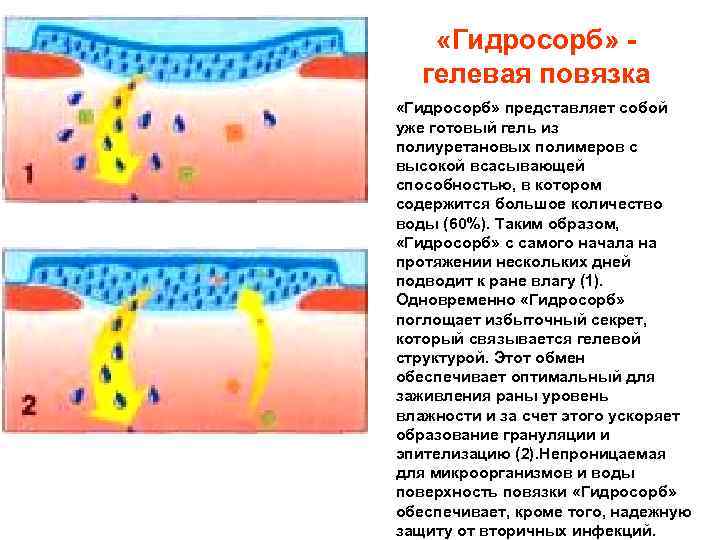  «Гидросорб» гелевая повязка «Гидросорб» представляет собой уже готовый гель из полиуретановых полимеров с