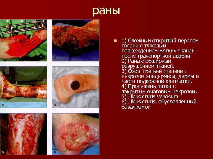 раны n 1) Сложный открытый перелом голени с тяжелым повреждением мягких тканей после транспортной