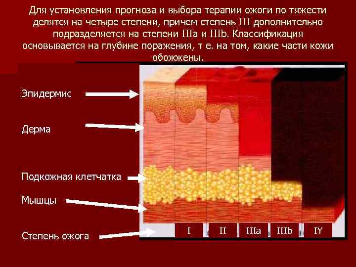 Для установления прогноза и выбора терапии ожоги по тяжести делятся на четыре степени, причем