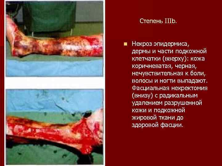 Степень IIIb. n Некроз эпидермиса, дермы и части подкожной клетчатки (вверху): кожа коричневатая, черная,