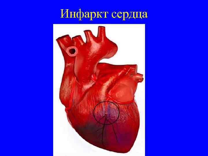 Инфаркт сердца 