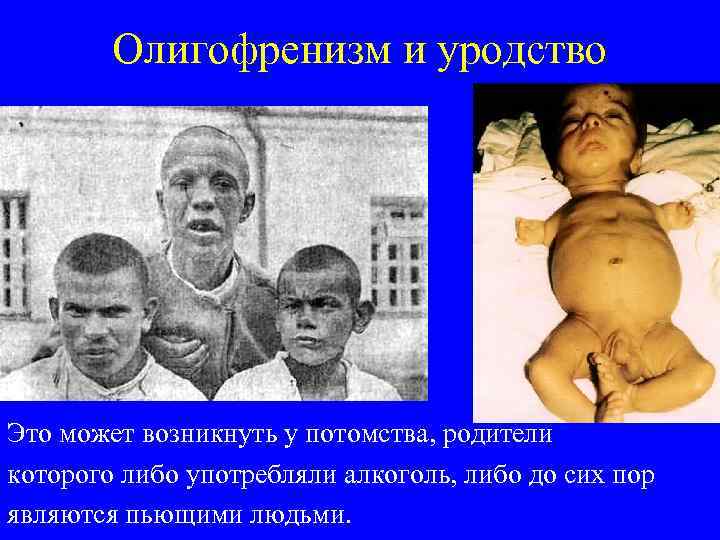 Олигофренизм и уродство Это может возникнуть у потомства, родители которого либо употребляли алкоголь, либо