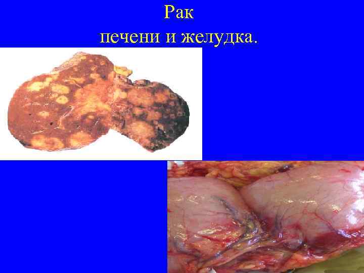 Рак печени и желудка. 