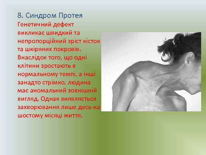 8. Синдром Протея Генетичний дефект викликає швидкий та непропорційний зріст кісток та шкіряних покровів.