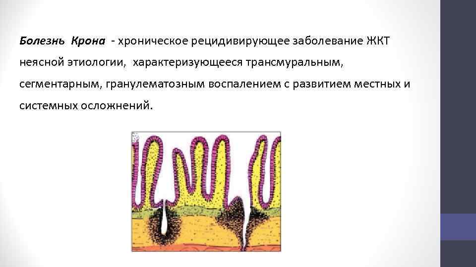 Болезнь Крона - хроническое рецидивирующее заболевание ЖКТ неясной этиологии, характеризующееся трансмуральным, сегментарным, гранулематозным воспалением