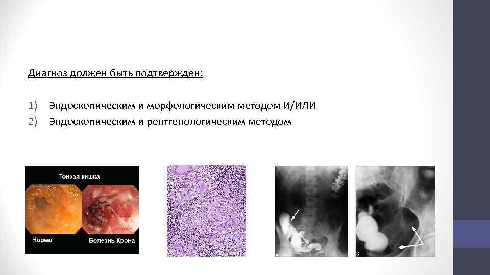 Диагноз должен быть подтвержден: 1) Эндоскопическим и морфологическим методом И/ИЛИ 2) Эндоскопическим и рентгенологическим