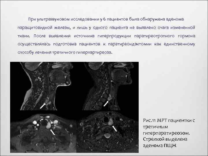 При ультразвуковом исследовании у 6 пациентов была обнаружена аденома паращитовидной железы, и лишь у